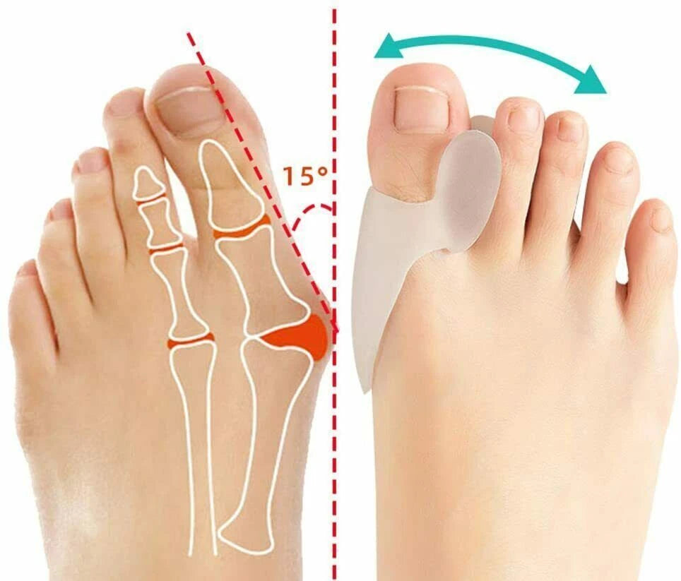 Side view of adjustable toe straightener for bunion support